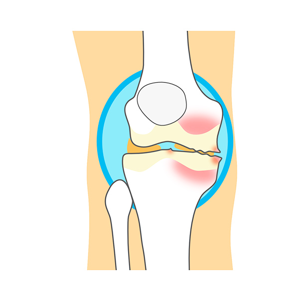 変形性膝関節症とは